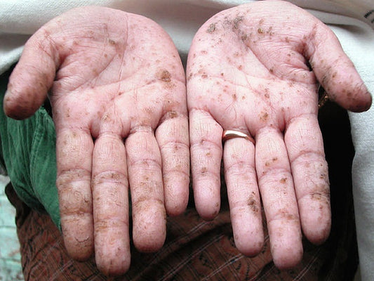 Study Identifies First Human Population Adapted to Arsenic